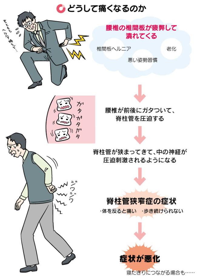 2大腰痛 椎間板ヘルニアと脊柱管狭窄症の症状と原因 新しい腰痛の教科書 酒井慎太郎 幻冬舎plus 2大腰痛 椎間板ヘルニアと脊柱管狭窄症の症状と原因 新しい腰痛の教科書 酒井慎太郎 幻冬舎plus